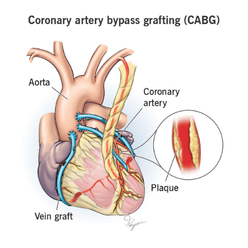 Coronary Artery Bypass Surgery