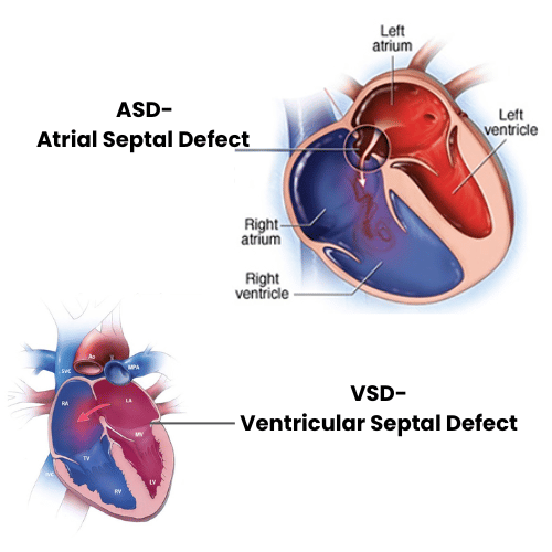 Congenital Heart Surgery (ASD/VSD Surgery)