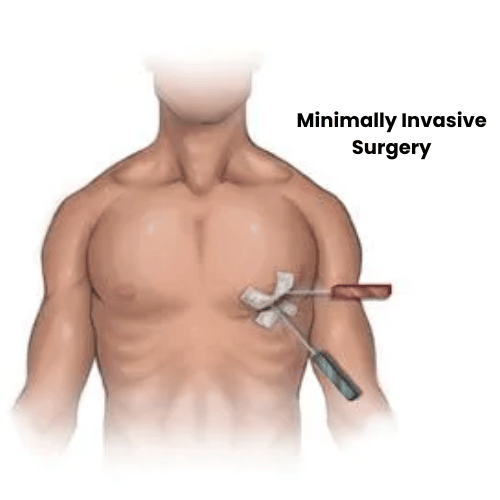 Minimally Invasive Surgery