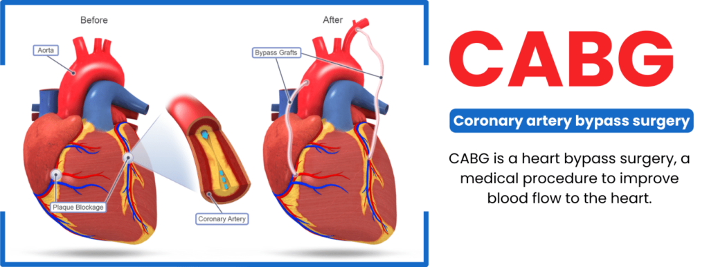 Coronary artery bypass surgery