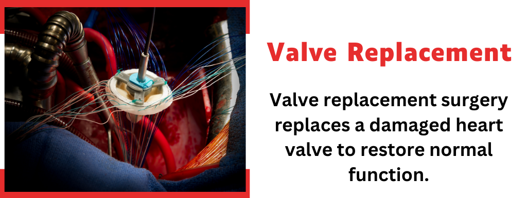 Valve Replacement